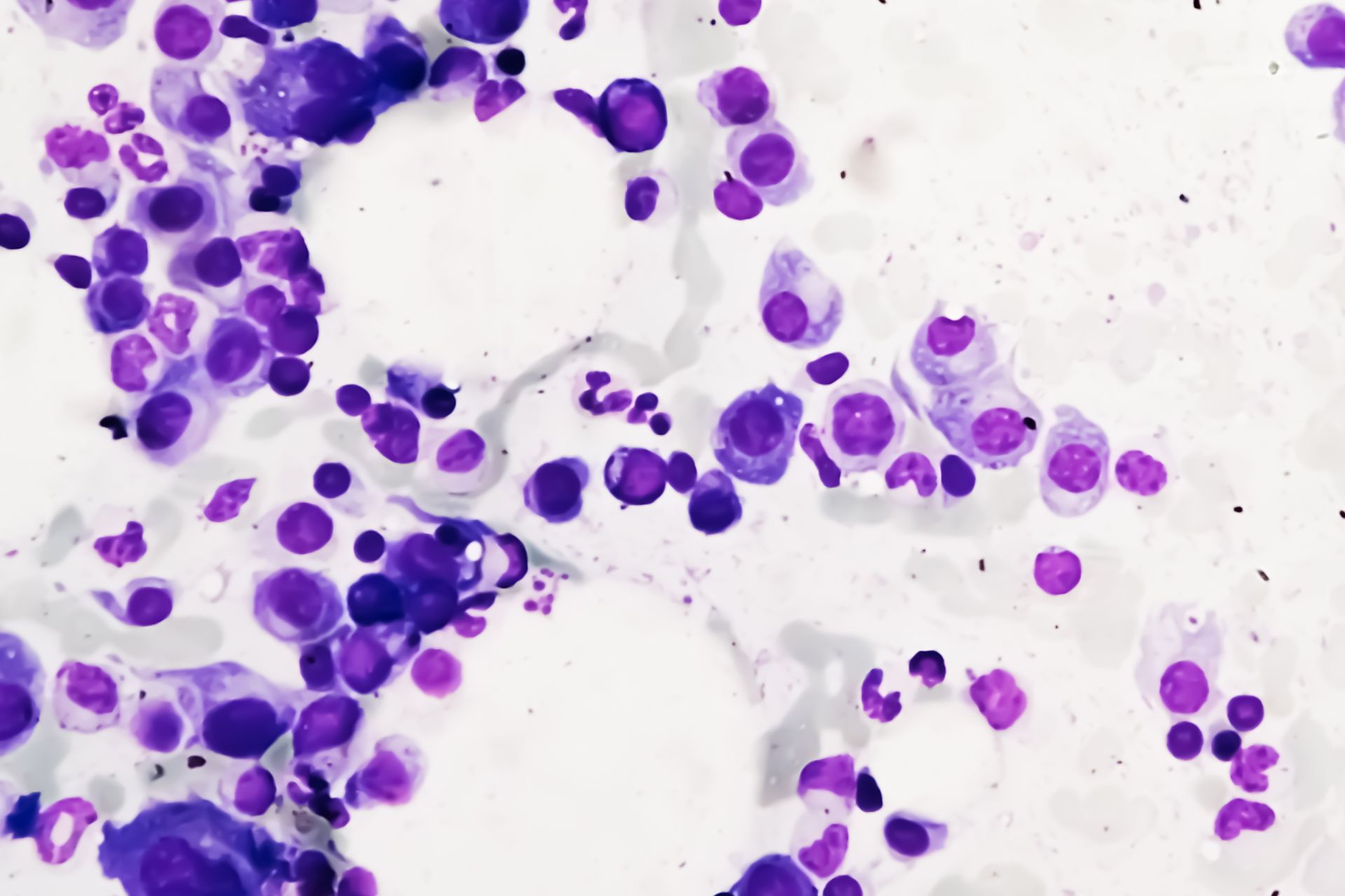 CONSULTORIO DR. SOCRATES MIELOMA MULTIPLE